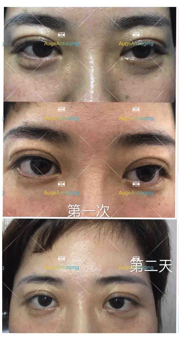 客户使用产品后的对比（黑眼圈）(图1)