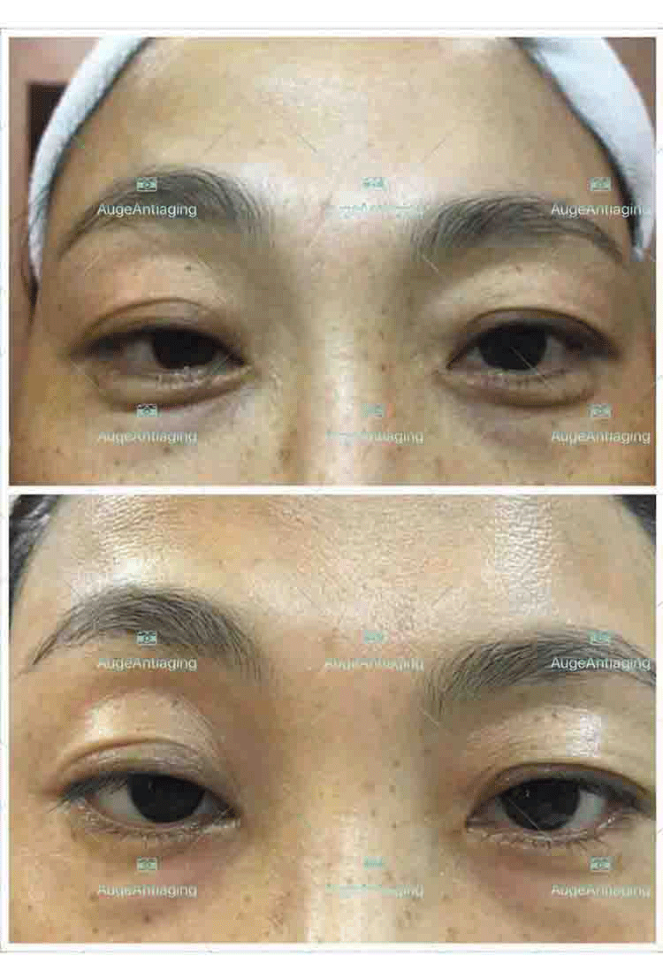 客户使用产品后的对比（黑眼圈）(图1)
