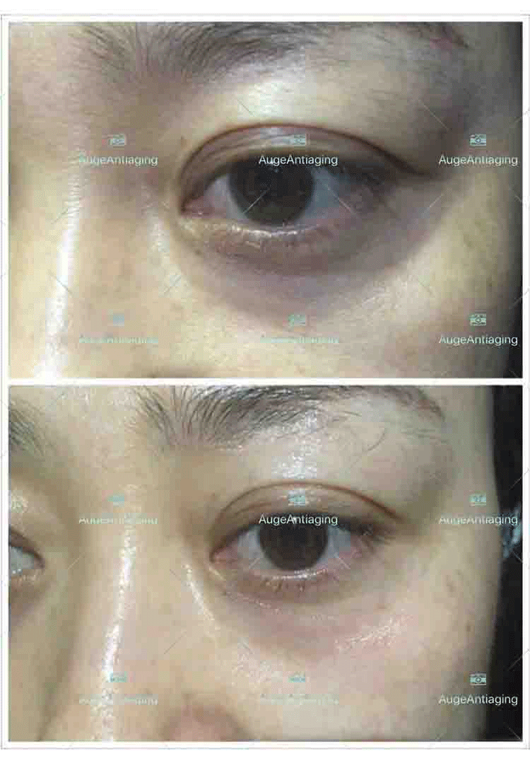 客户使用产品后的对比（黑眼圈）(图1)