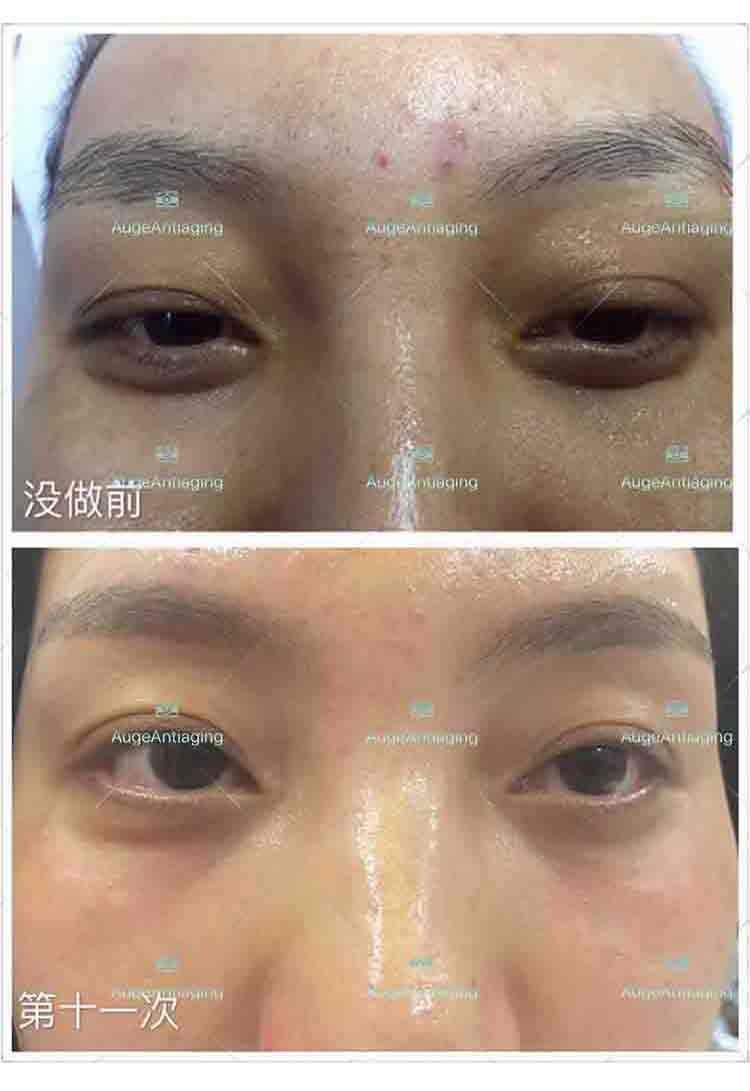 客户使用产品后的对比（黑眼圈）(图1)