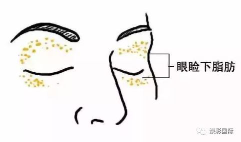 【焕彩国际】为什么会长脂肪粒？(图3)